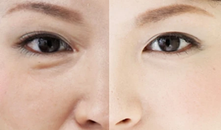 正确谨慎选择眼部美容项目是必要的，你了解眼部美容项目有哪些吗